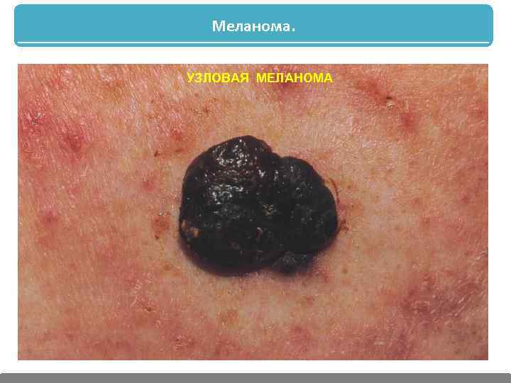 Меланома. УЗЛОВАЯ МЕЛАНОМА 