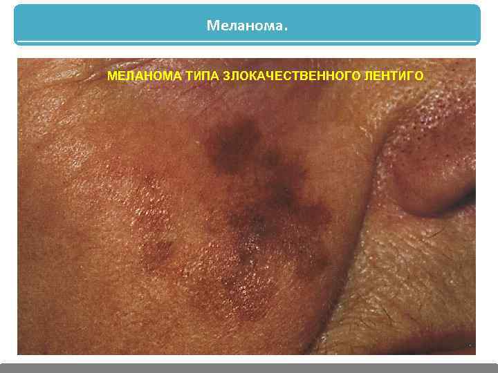 Меланома. МЕЛАНОМА ТИПА ЗЛОКАЧЕСТВЕННОГО ЛЕНТИГО 