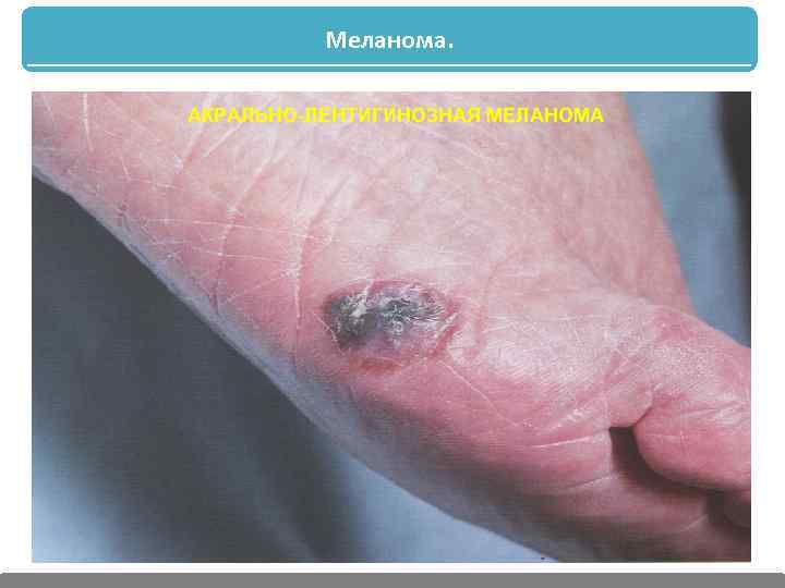 Меланома. АКРАЛЬНО-ЛЕНТИГИНОЗНАЯ МЕЛАНОМА 