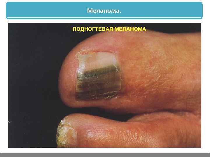 Меланома. ПОДНОГТЕВАЯ МЕЛАНОМА 
