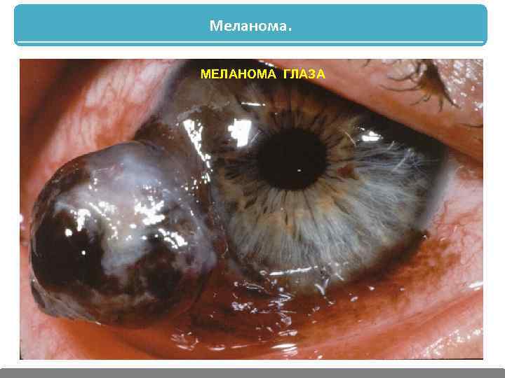 Меланома. МЕЛАНОМА ГЛАЗА 