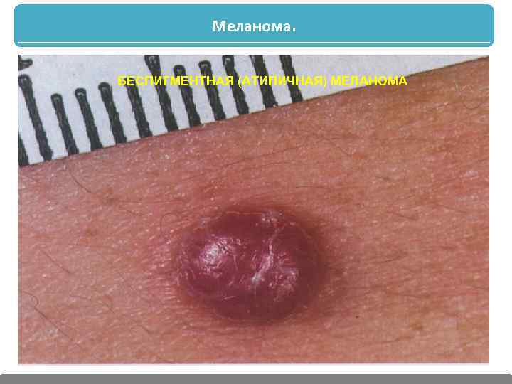 Меланома. БЕСПИГМЕНТНАЯ (АТИПИЧНАЯ) МЕЛАНОМА 