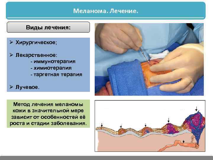 Меланома. Лечение. Виды лечения: Ø Хирургическое; Ø Лекарственное: - иммунотерапия - химиотерапия - таргетная