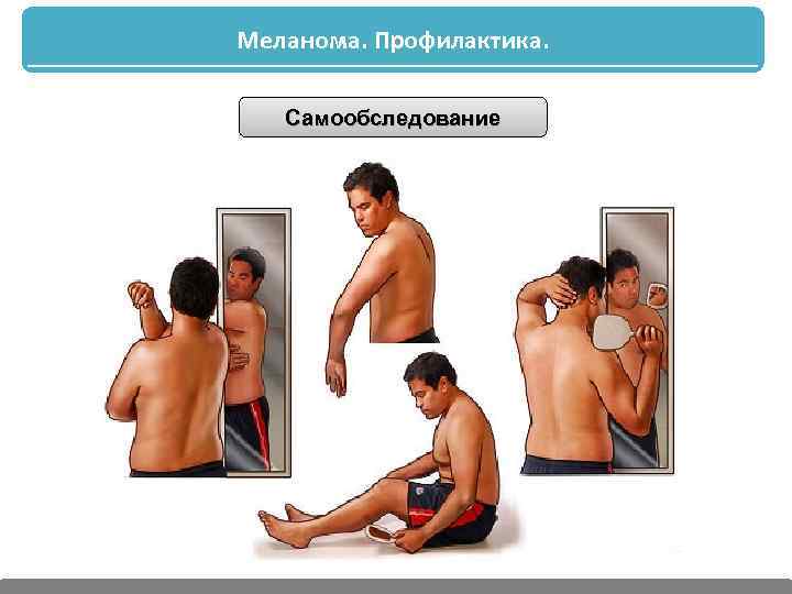 Меланома. Профилактика. Самообследование 
