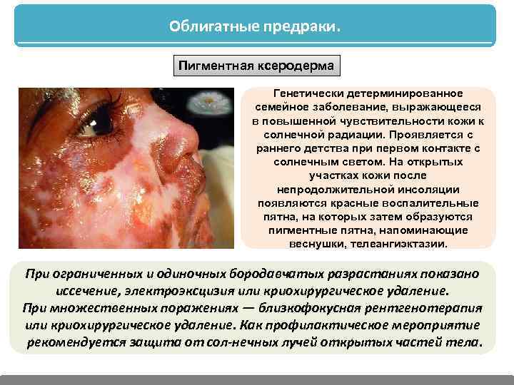 Облигатные предраки. Пигментная ксеродерма Генетически детерминированное семейное заболевание, выражающееся в повышенной чувствительности кожи к