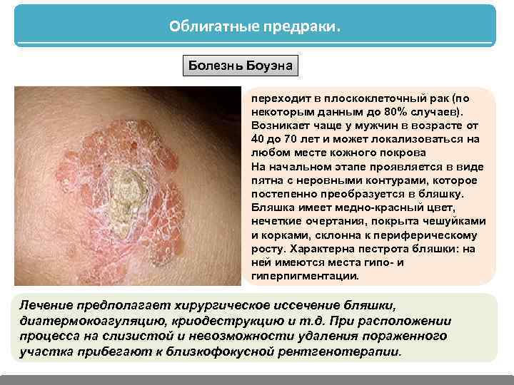 Облигатные предраки. Болезнь Боуэна переходит в плоскоклеточный рак (по некоторым данным до 80% случаев).