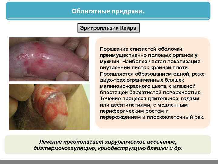 Облигатные предраки. Эритроплазия Кейра Поражение слизистой оболочки преимущественно половых органов у мужчин. Наиболее частая