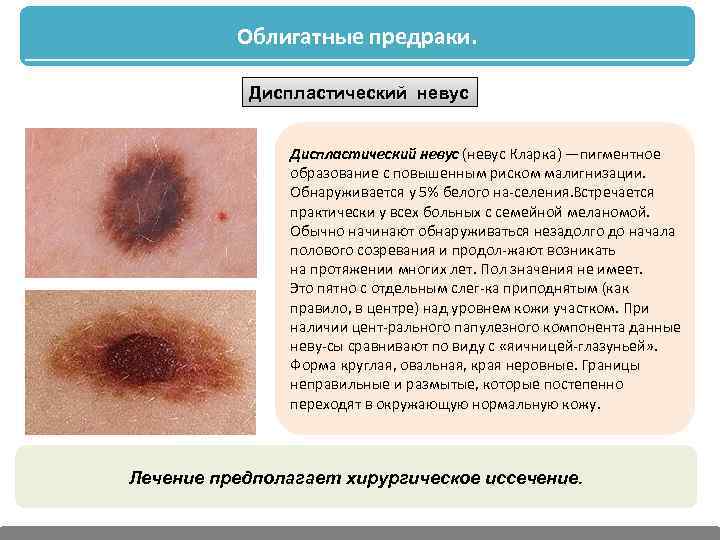 Облигатные предраки. Диспластический невус (невус Кларка) —пигментное образование с повышенным риском малигнизации. Обнаруживается у