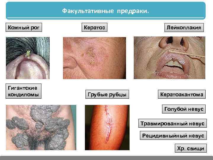 Факультативные предраки. Кожный рог Гигантские кондиломы Кератоз Грубые рубцы Лейкоплакия Кератоакантома Голубой невус Травмированный