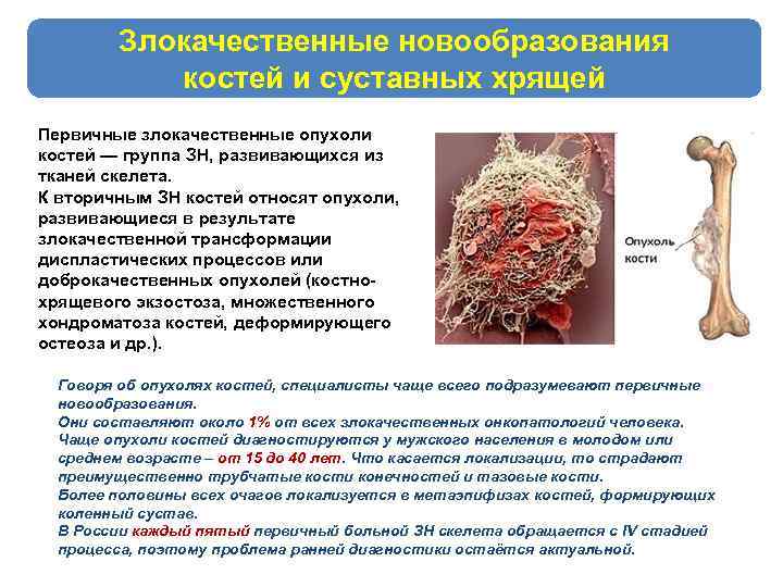 Злокачественные новообразования костей и суставных хрящей Первичные злокачественные опухоли костей — группа ЗН, развивающихся