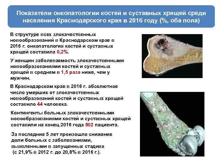 Показатели онкопатологии костей и суставных хрящей среди населения Краснодарского края в 2016 году (%,