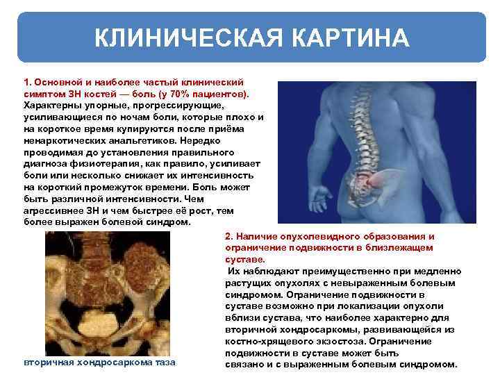КЛИНИЧЕСКАЯ КАРТИНА 1. Основной и наиболее частый клинический симптом ЗН костей — боль (у