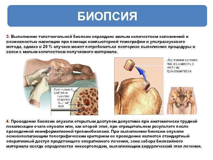 БИОПСИЯ 3. Выполнение толстоигольной биопсии оправдано малым количеством осложнений и возможностью навигации при помощи