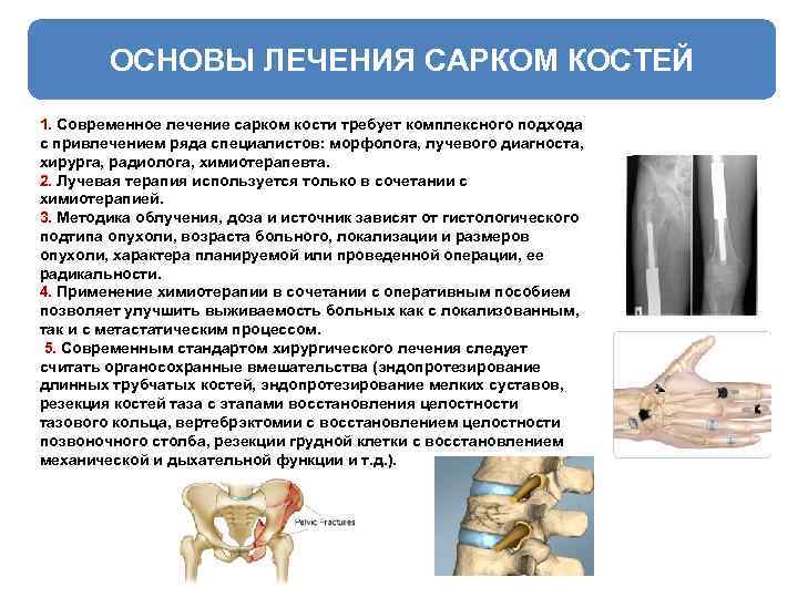 ОСНОВЫ ЛЕЧЕНИЯ САРКОМ КОСТЕЙ 1. Современное лечение сарком кости требует комплексного подхода с привлечением