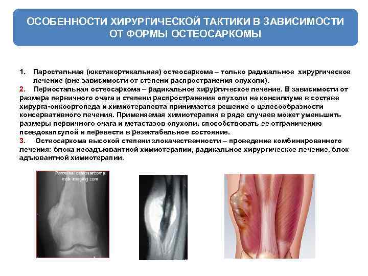 ОСОБЕННОСТИ ХИРУРГИЧЕСКОЙ ТАКТИКИ В ЗАВИСИМОСТИ ОТ ФОРМЫ ОСТЕОСАРКОМЫ 1. Паростальная (юкстакортикальная) остеосаркома – только
