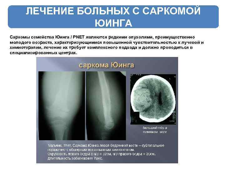 ЛЕЧЕНИЕ БОЛЬНЫХ С САРКОМОЙ ЮИНГА Саркомы семейства Юинга / PNET являются редкими опухолями, преимущественно