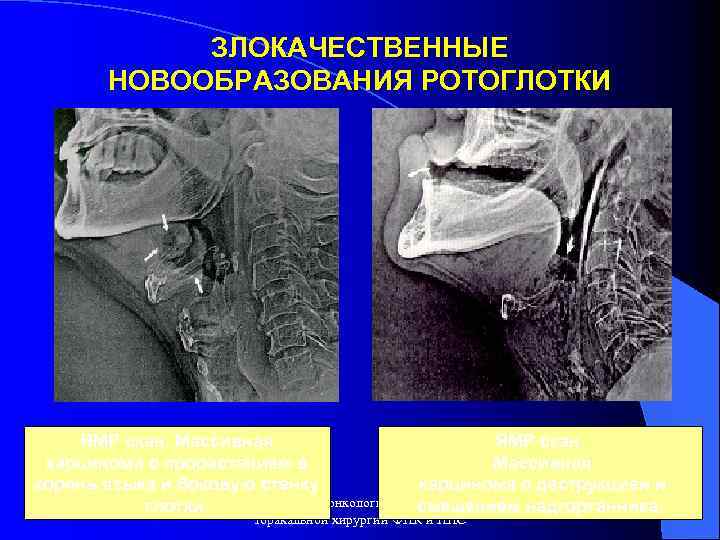 ЗЛОКАЧЕСТВЕННЫЕ НОВООБРАЗОВАНИЯ РОТОГЛОТКИ ЯМР скан. Массивная ЯМР скан. карцинома с прорастанием в Массивная корень