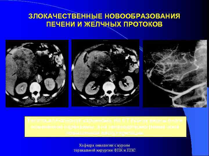 ЗЛОКАЧЕСТВЕННЫЕ НОВООБРАЗОВАНИЯ ПЕЧЕНИ И ЖЕЛЧНЫХ ПРОТОКОВ Гепатоцеллюлярная карцинома. На СТ сканах видны очаги измененной