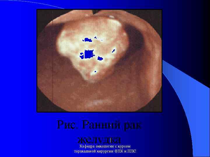 Кафедра онкологии с курсом торакальной хирургии ФПК и ППС 