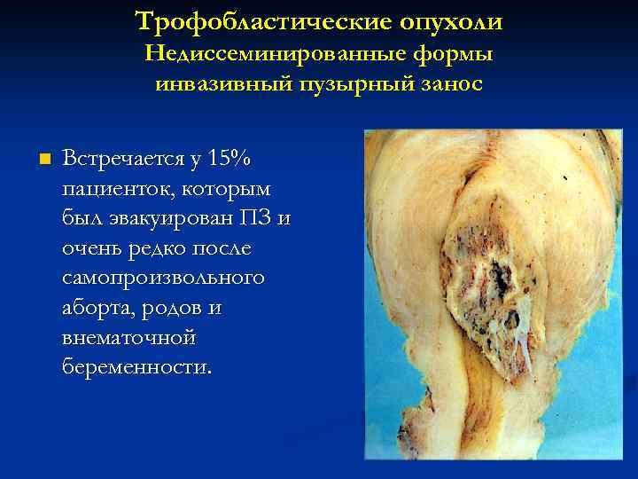 Трофобластические опухоли Недиссеминированные формы инвазивный пузырный занос n Встречается у 15% пациенток, которым был