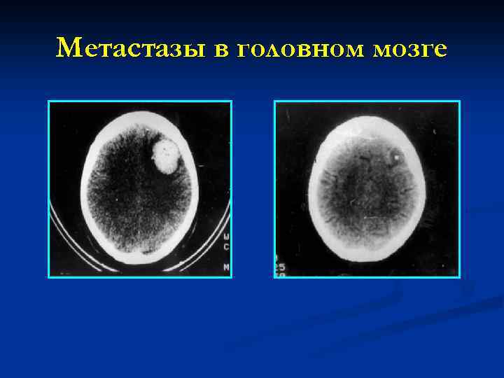Метастазы в головном мозге 