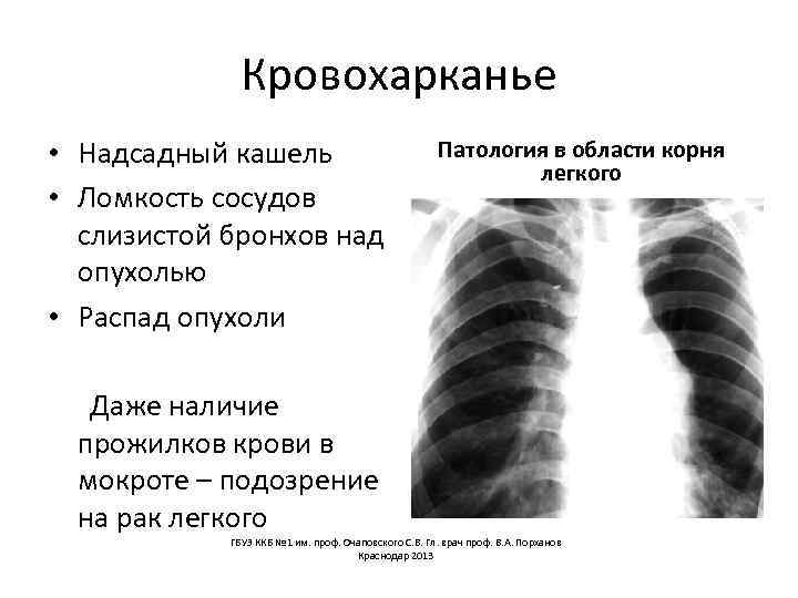 Кровохарканье • Надсадный кашель • Ломкость сосудов слизистой бронхов над опухолью • Распад опухоли