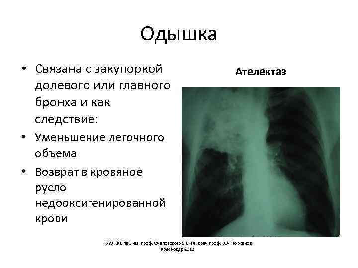 Одышка • Связана с закупоркой долевого или главного бронха и как следствие: Ателектаз •