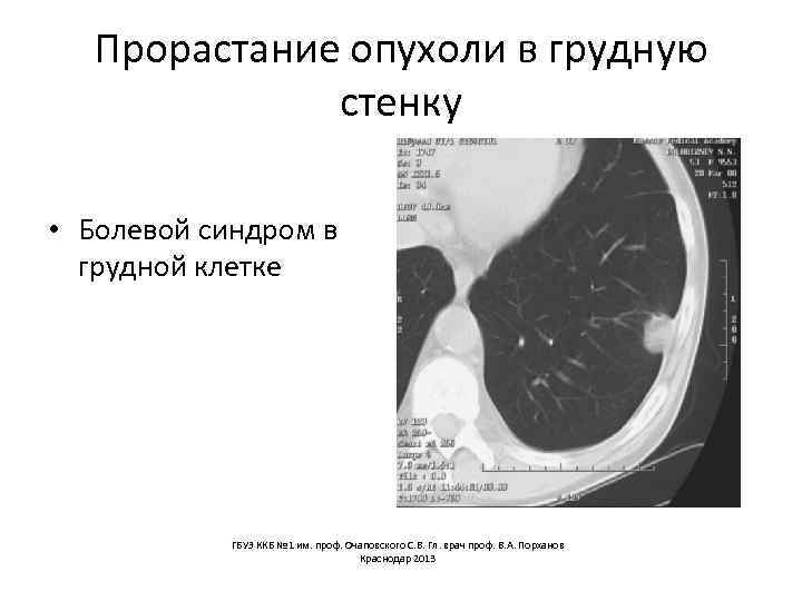 Прорастание опухоли в грудную стенку • Болевой синдром в грудной клетке ГБУЗ ККБ №
