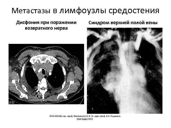 Метастазы в лимфоузлы средостения Дисфония при поражении возвратного нерва Синдром верхней полой вены ГБУЗ