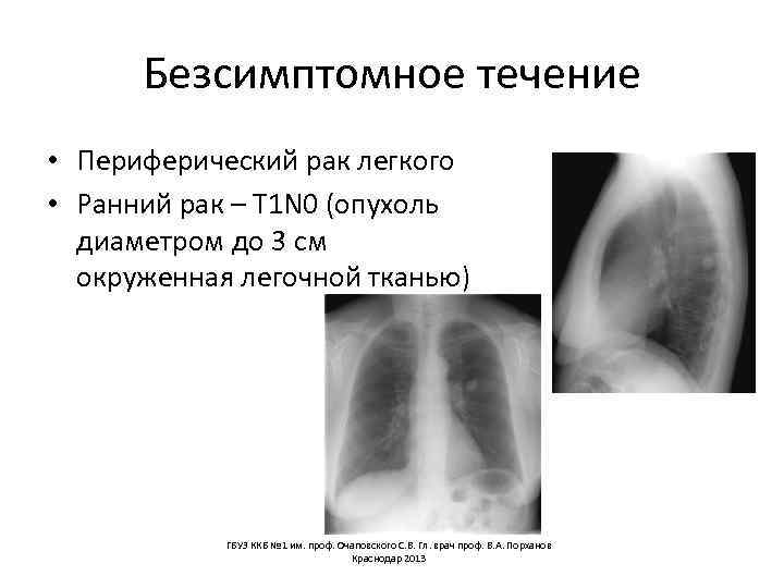 Безсимптомное течение • Периферический рак легкого • Ранний рак – Т 1 N 0