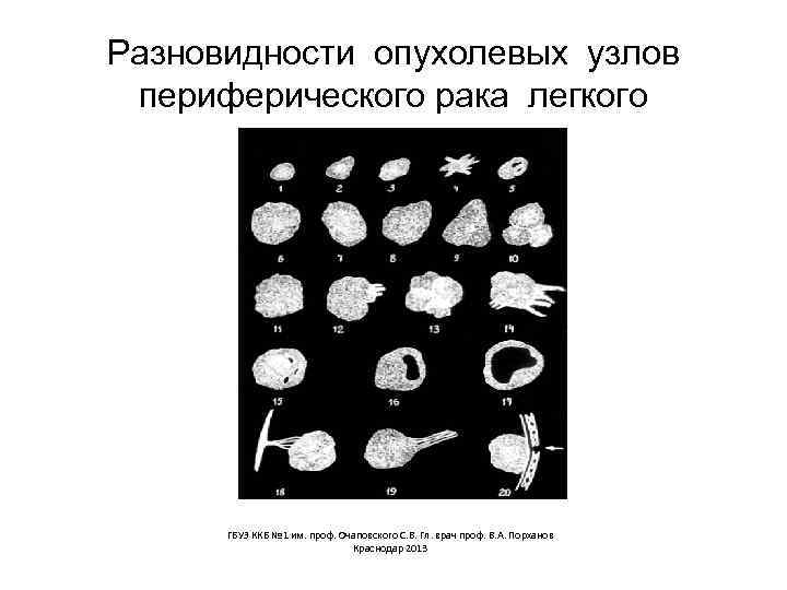 Разновидности опухолевых узлов периферического рака легкого ГБУЗ ККБ № 1 им. проф. Очаповского С.