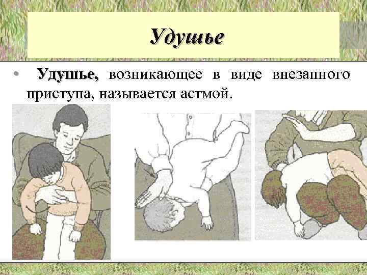 Удушье • Удушье, возникающее в виде внезапного приступа, называется астмой. 