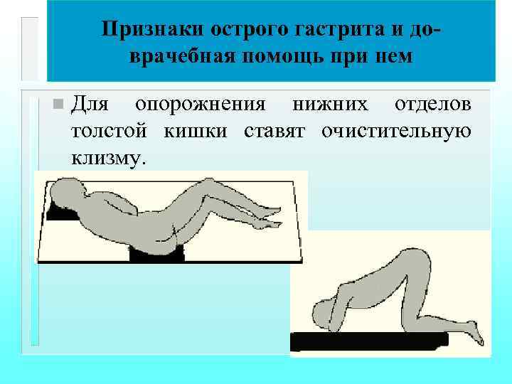 Признаки острого гастрита и доврачебная помощь при нем n Для опорожнения нижних отделов толстой