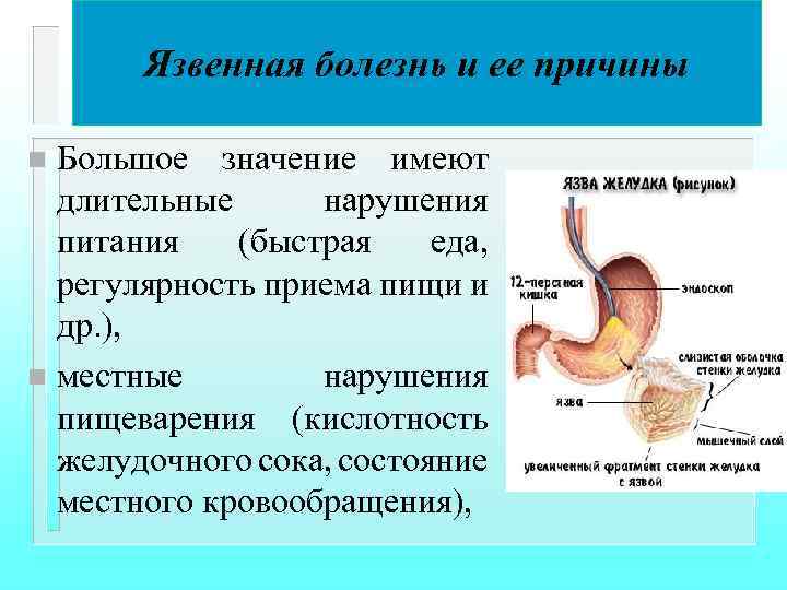 Язвенная болезнь и ее причины Большое значение имеют длительные нарушения питания (быстрая еда, регулярность