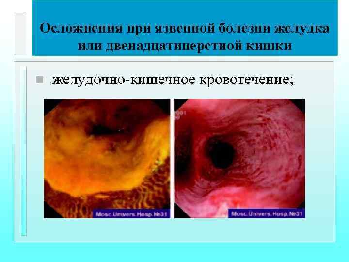 Осложнения при язвенной болезни желудка или двенадцатиперстной кишки n желудочно-кишечное кровотечение; 