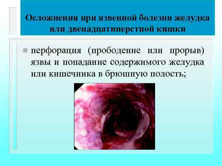 Осложнения при язвенной болезни желудка или двенадцатиперстной кишки n перфорация (прободение или прорыв) язвы
