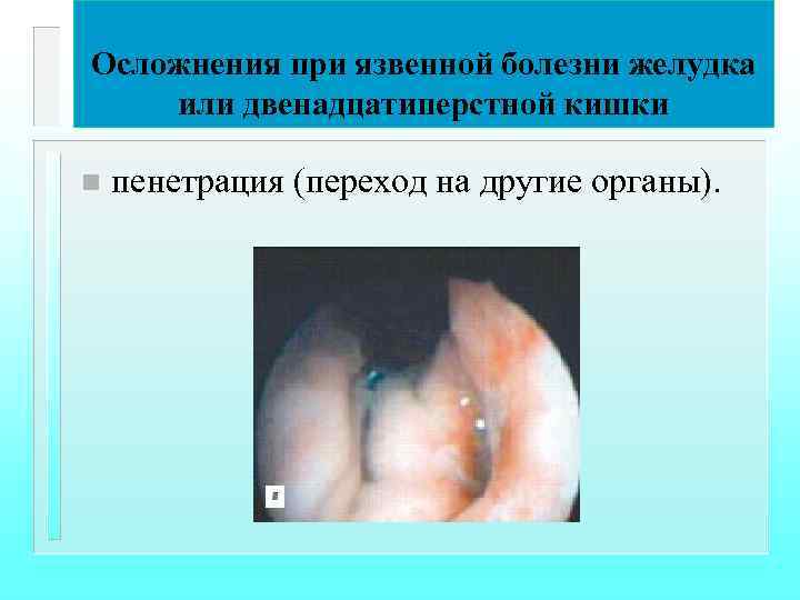 Осложнения при язвенной болезни желудка или двенадцатиперстной кишки n пенетрация (переход на другие органы).