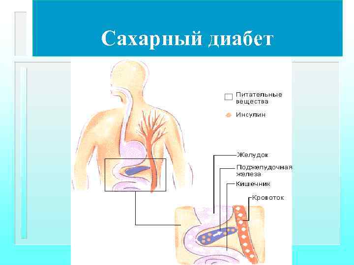 Сахарный диабет 