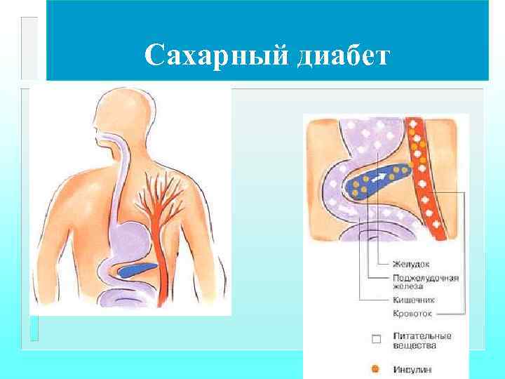 Сахарный диабет 