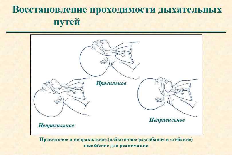 Последовательность восстановления проходимости дыхательных путей