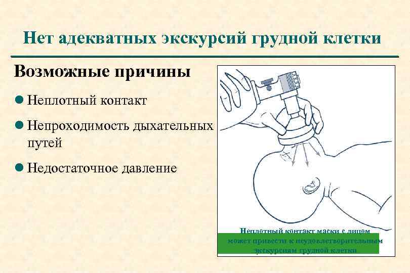 Нет адекватных экскурсий грудной клетки Возможные причины l Неплотный контакт l Непроходимость дыхательных путей