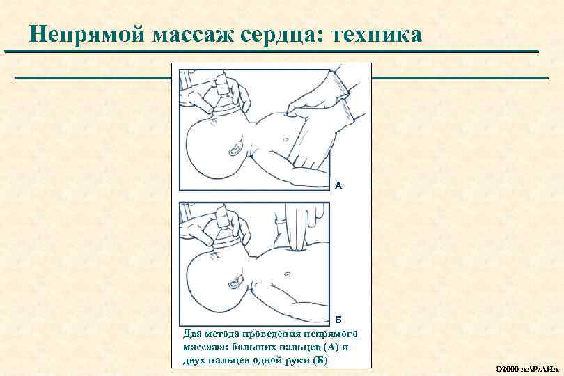 Непрямой массаж сердца: техника А Б Два метода проведения непрямого массажа: больших пальцев (А)