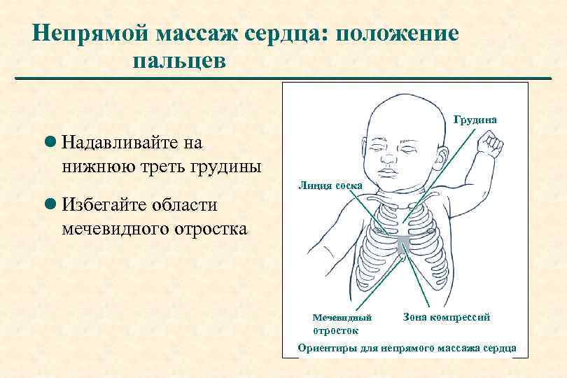 Непрямой массаж сердца: положение пальцев Грудина l Надавливайте на нижнюю треть грудины Линия соска