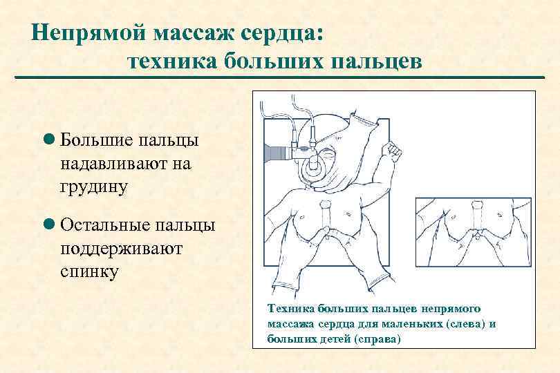 Непрямой массаж сердца: техника больших пальцев l Большие пальцы надавливают на грудину l Остальные