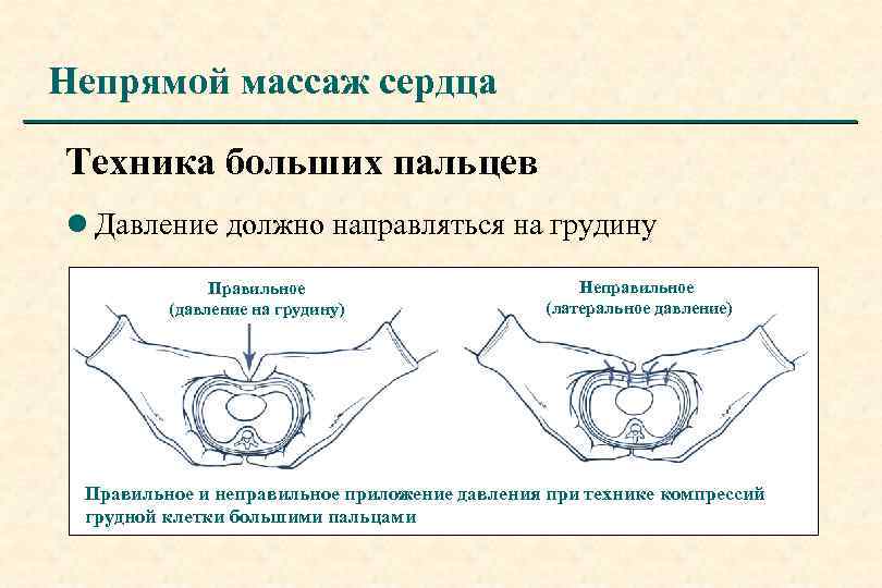 Непрямой массаж сердца Техника больших пальцев l Давление должно направляться на грудину Правильное (давление