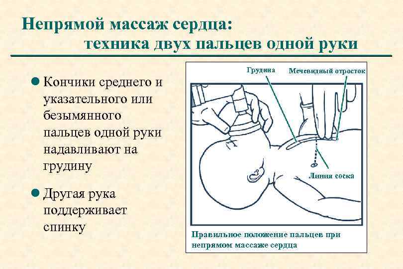 Непрямой массаж сердца: техника двух пальцев одной руки l Кончики среднего и указательного или