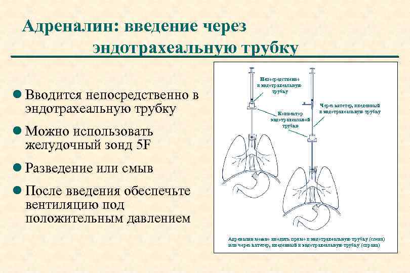 Адреналин: введение через эндотрахеальную трубку l Вводится непосредственно в эндотрахеальную трубку l Можно использовать