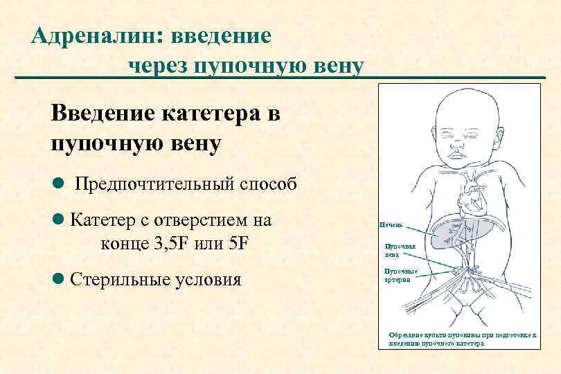 Адреналин: введение через пупочную вену Введение катетера в пупочную вену l Предпочтительный способ l