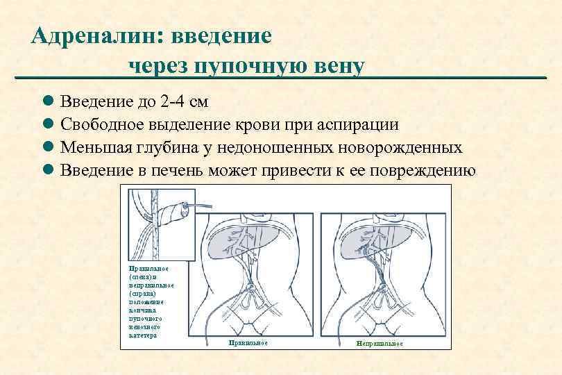 Адреналин: введение через пупочную вену l Введение до 2 -4 см l Свободное выделение
