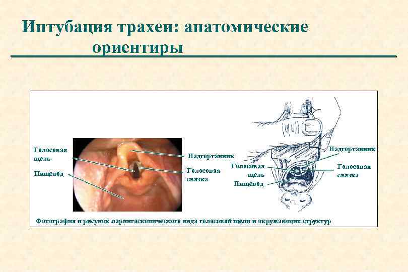 Интубация трахеи: анатомические ориентиры Голосовая щель Пищевод Надгортанник Голосовая щель связка Пищевод Надгортанник Фотография